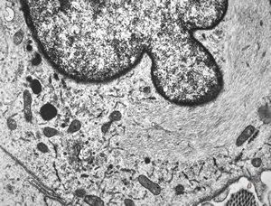 F, 49y. | myelosarcoma … histiocyte-like cells in dermal infiltrates